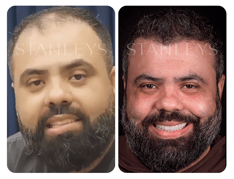 Antes e depois 1