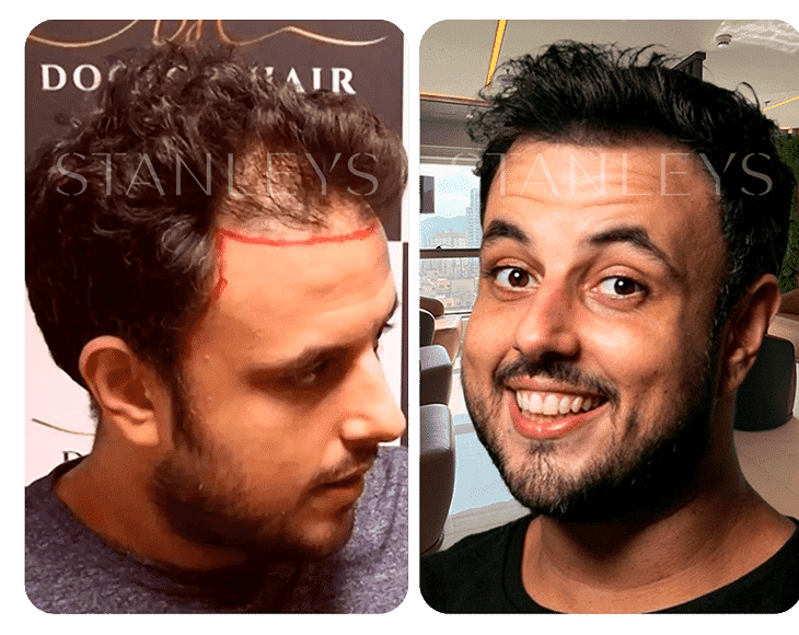 Antes e depois 3