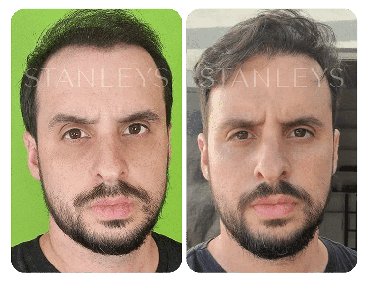 Antes e depois 4