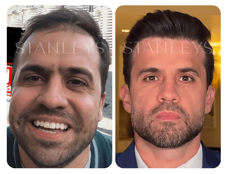 Antes e depois 5