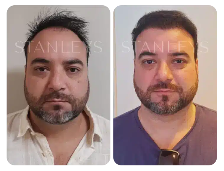 Antes e depois 6