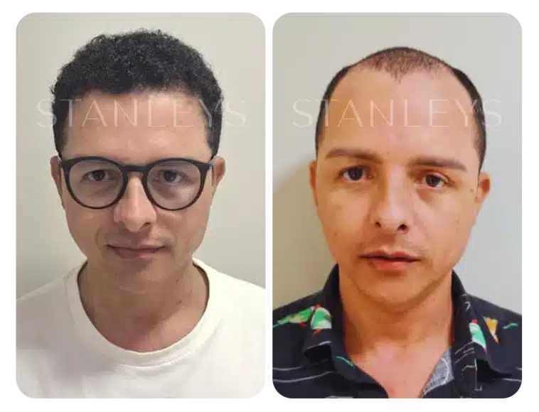Antes e depois 7