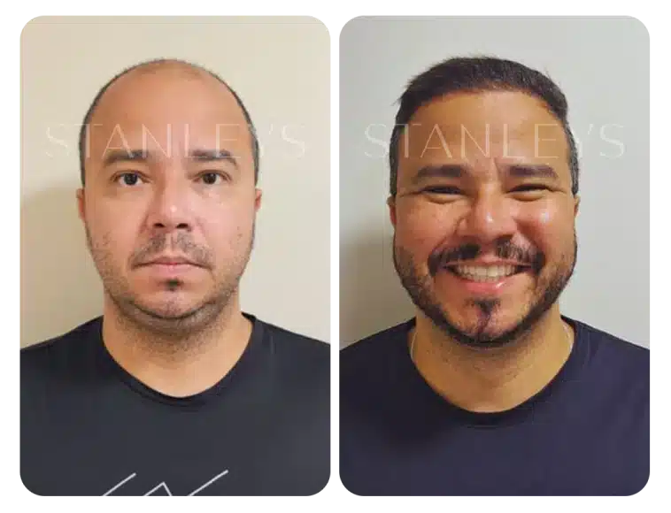 Antes e depois 8