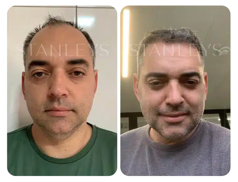 Antes e depois 9