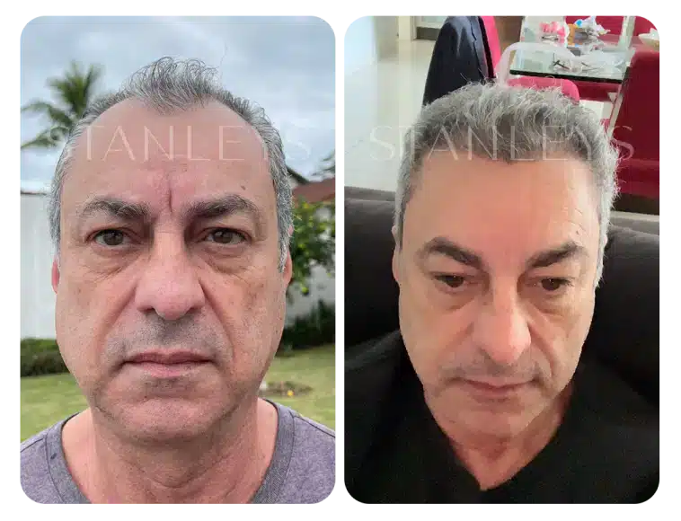 Antes e depois 10