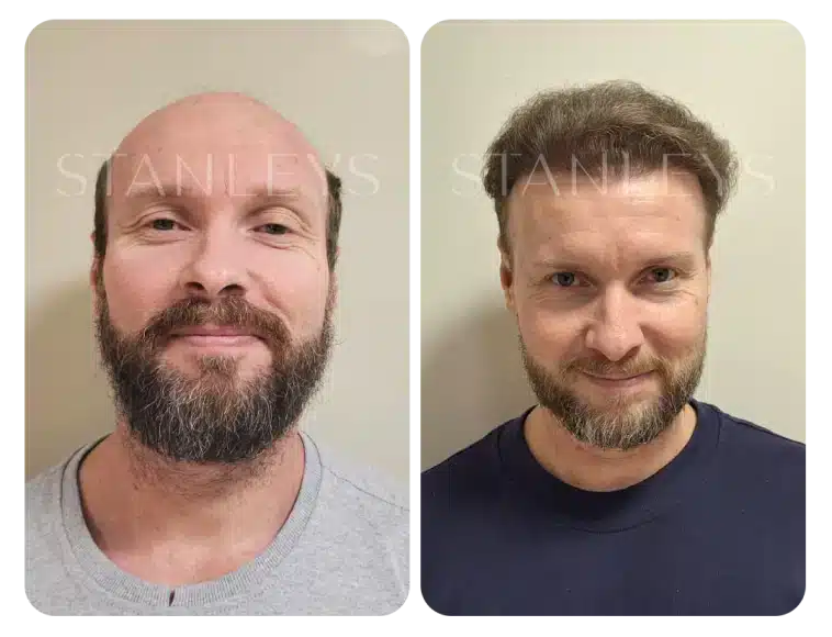 Antes e depois 11