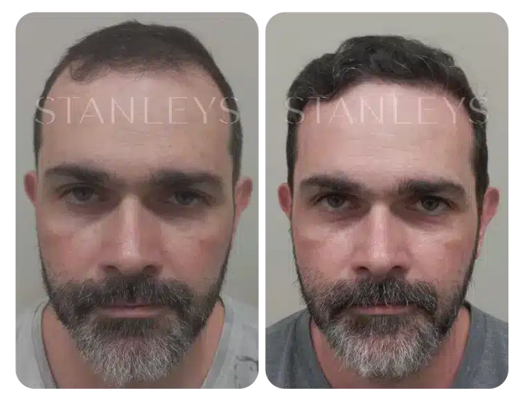 Antes e depois 12