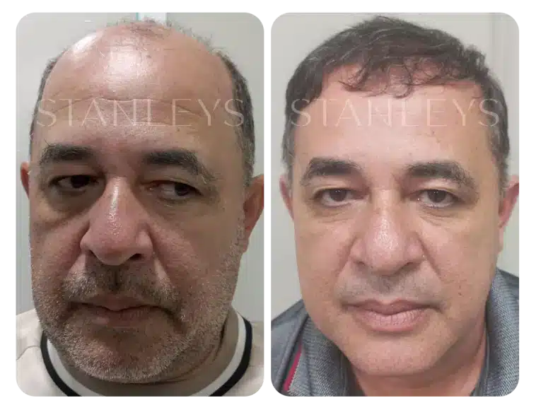 Antes e depois 13