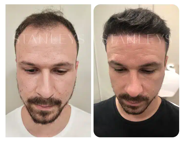 Antes e depois 14