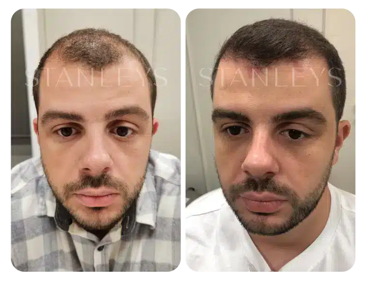Antes e depois 15