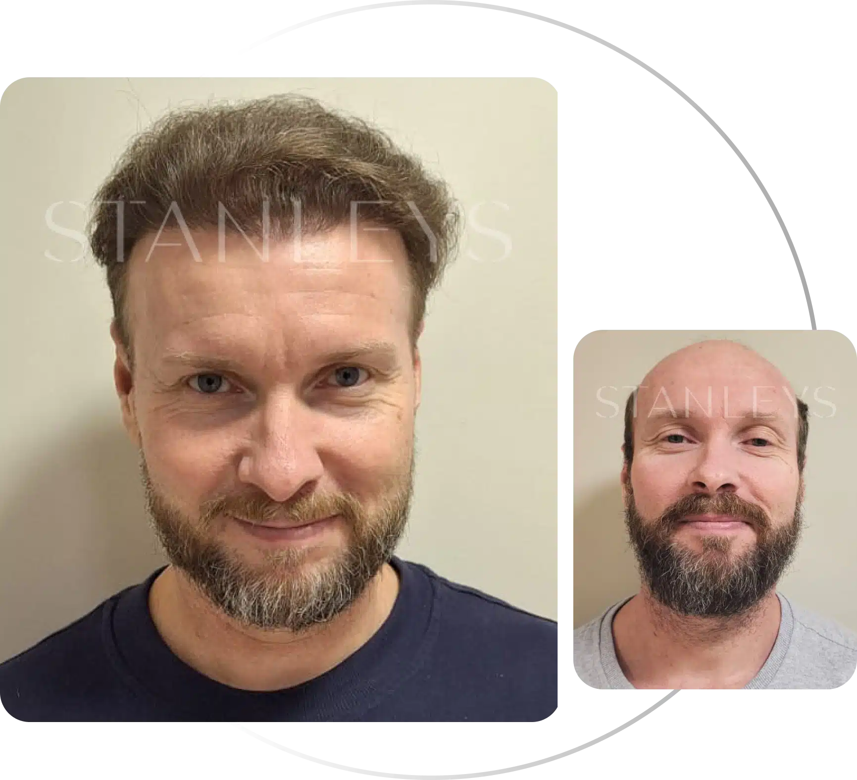 Antes e depois de transplante capilar