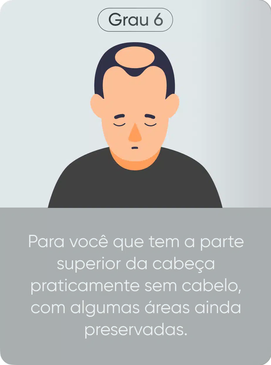Grau de calvície 6